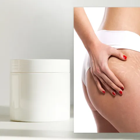 stretch marks product for pregnancy anti stretch mark cream  stretch marks cream